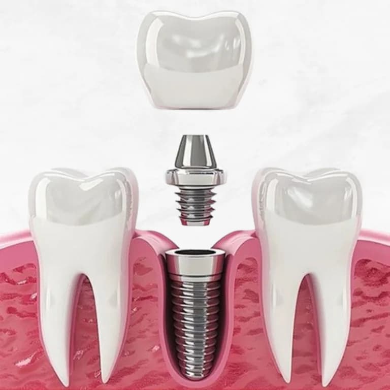 زراعة الأسنان – الحل للأسنان المفقودة