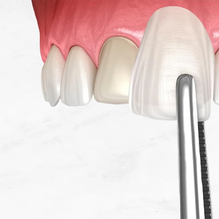 الفينيرز وابتسامة هوليود – جمالك في أول نظرة